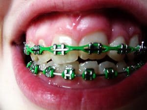 Vancouver orthodontist-braces care